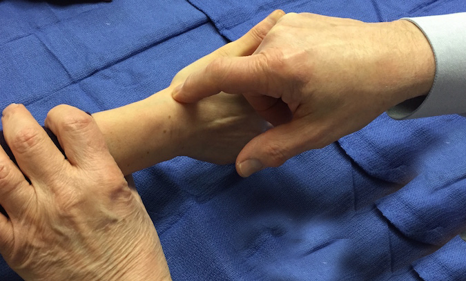 osteoarthritis-scaphotrapezial-trapezoid-stt-joint-hand-surgery